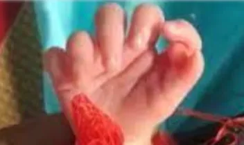 A baby girl was born with 26 fingers in Bharatpur, Rajasthan, India.