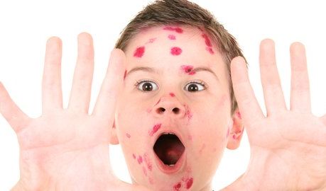 Karena ketiga penyakit ini disebabkan oleh virus, pengobatannya berfokus pada meredakan gejala hingga infeksi sembuh. 