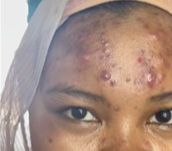 Gak Pede karena Wajah Penuh Jerawat Batu, MUA Ini Rias Pengantin sampai Jadi Halus Banget