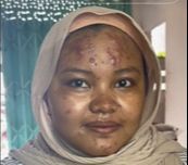 Gak Pede karena Wajah Penuh Jerawat Batu, MUA Ini Rias Pengantin sampai Jadi Halus Banget