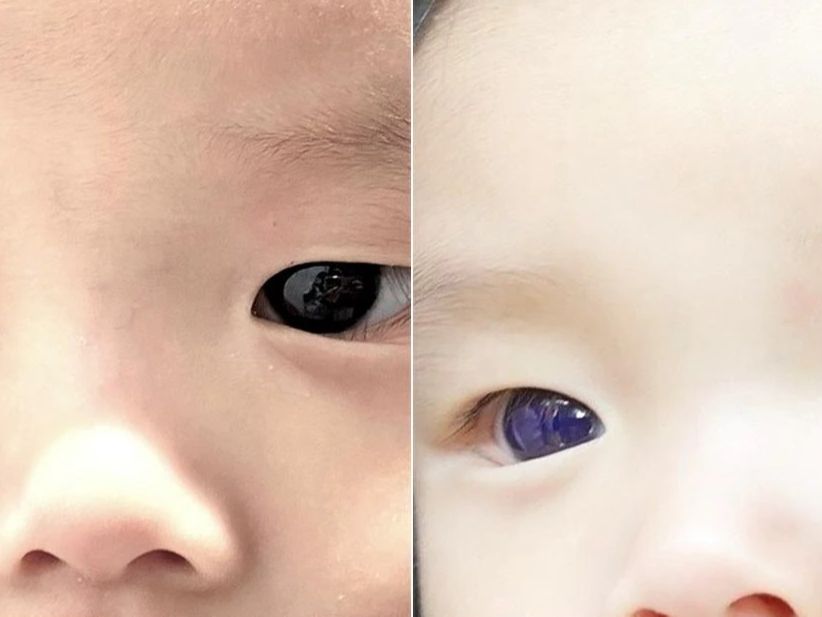 Thai Baby's Eyes Turned Blue Just One Night After Covid19 Treatment