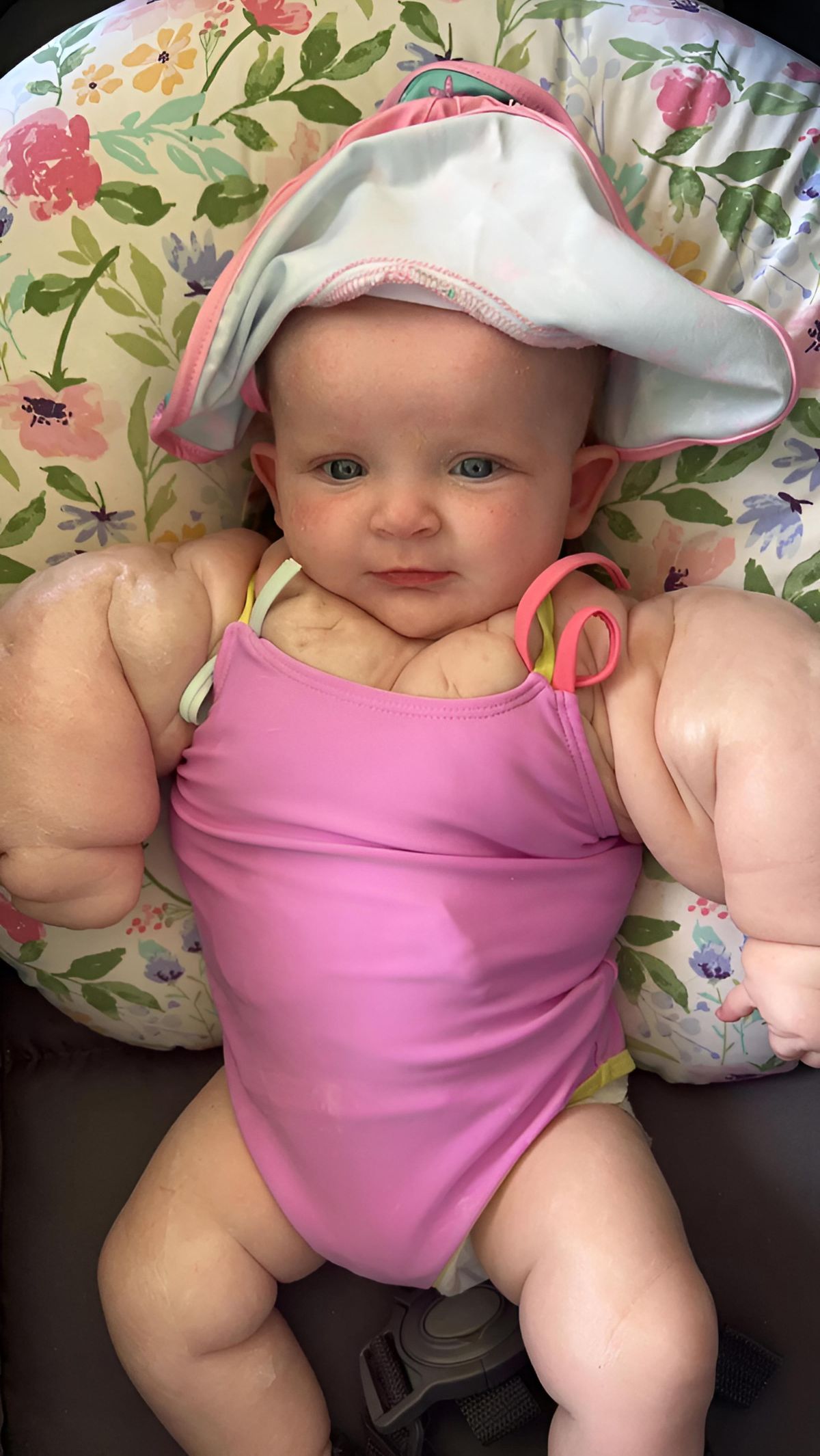 Viral! Foto-Foto Bayi Lahir Prematur dengan Dada dan Lengan Besar, Dijuluki 'Bayi Hulk'