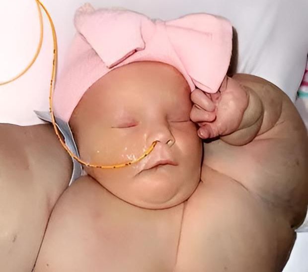 Viral! Foto-Foto Bayi Lahir Prematur dengan Dada dan Lengan Besar, Dijuluki 'Bayi Hulk'