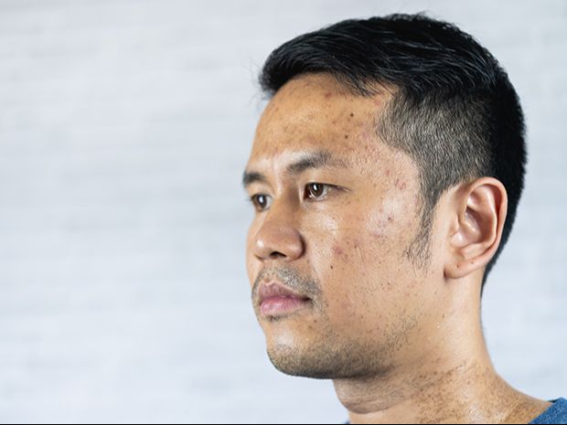 Gengsi tapi Takut Jerawatan, Cuma 1 dari 10 Cowok Pakai Sunscreen