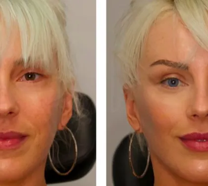 Keratopigmentation, New Procedure That You Can Change Eye Color