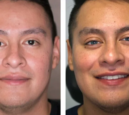 Keratopigmentation, New Procedure That You Can Change Eye Color