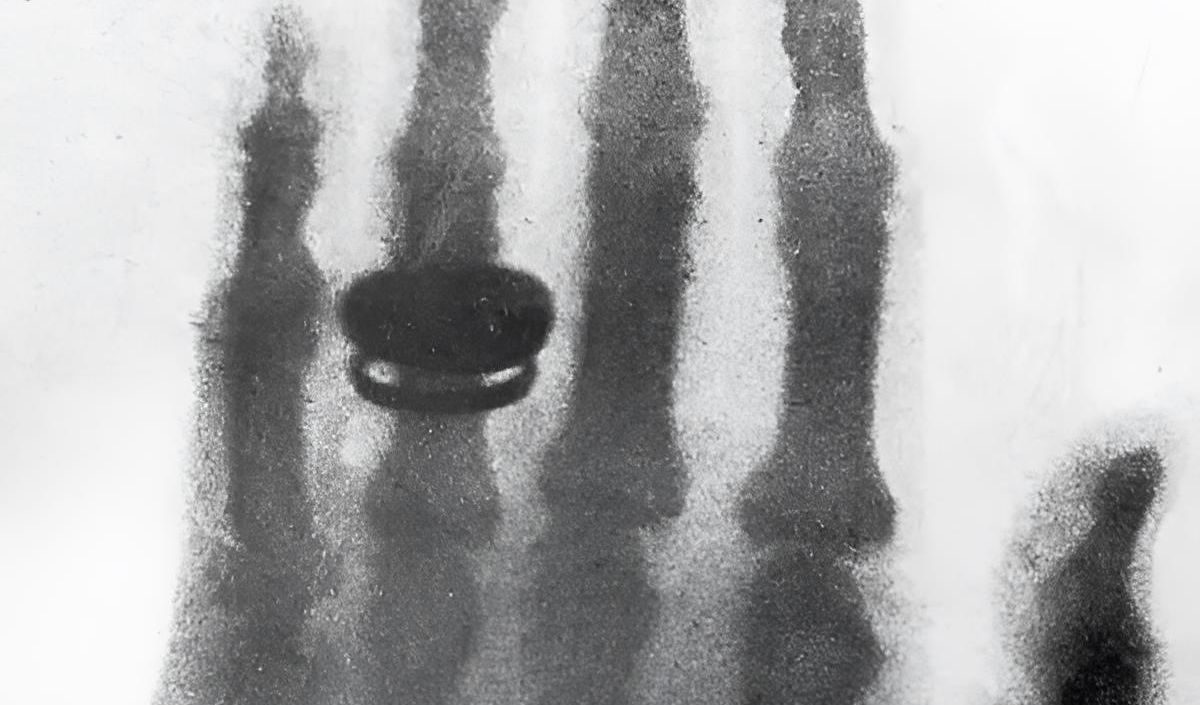 Hasil rontgen ini diambil oleh sang penemu foto rontgen itu sendiri yaitu Wilhelm Conrad Rntgen.