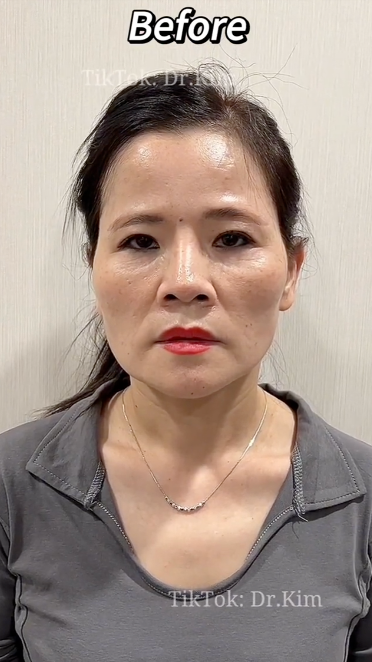 Potret Transformasi Kontroversial  Pasien Dr. Kim,  Spesialis Bedah Plastik yang Viral di TikTok