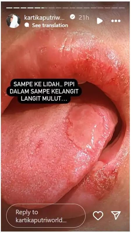 Bahkan ruam tersebut sampai ke dalam lidah dan langit-langit mulut.
