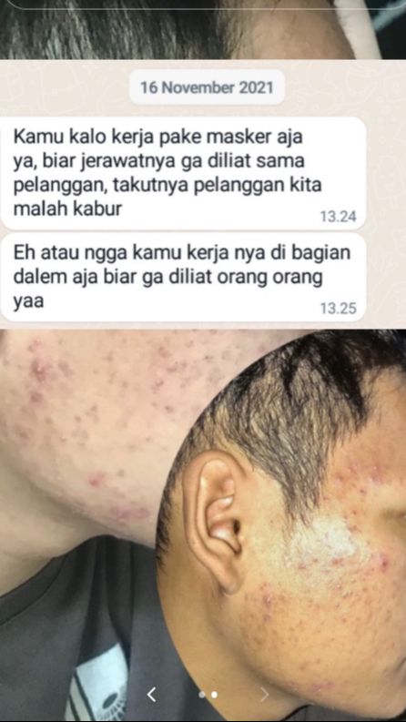 Cerita Karyawan Diminta Pakai Masker Saat Bertemu Pelanggan karena Jerawat Ini Bikin Nyesek