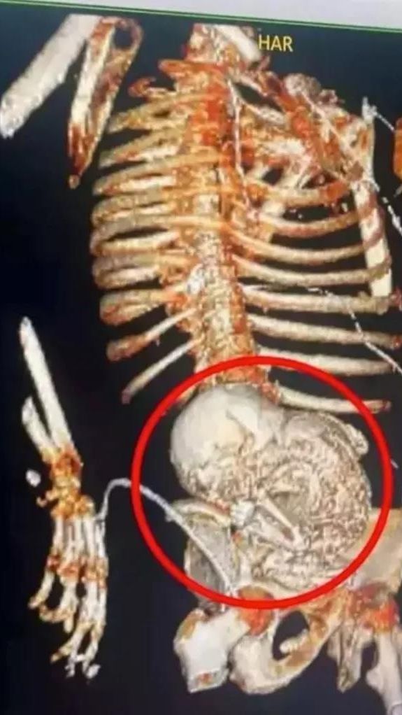 Perut Membesar Dikira Kanker, Nenek 81 Tahun Ternyata `Hamil` Selama 50 Tahun Sampai Janin Membatu