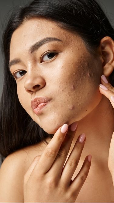 Step Skincare Penting Saat Kulit Sedang Berjerawat
