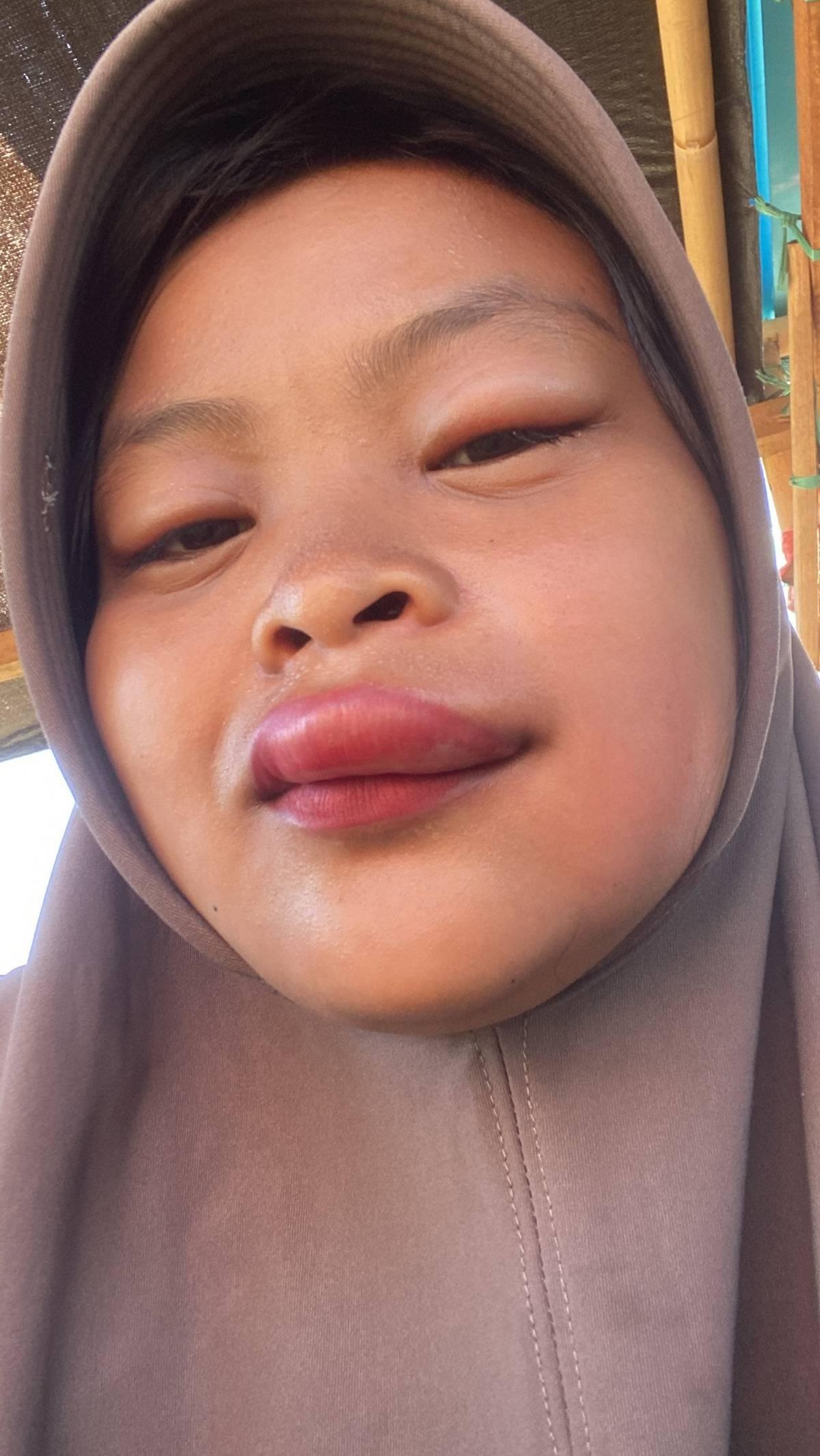 Gegara Naik Sepeda Motor Tak Pakai Masker, Bibir Cewek Ini Berakhir Bengkak Dientup Tawon