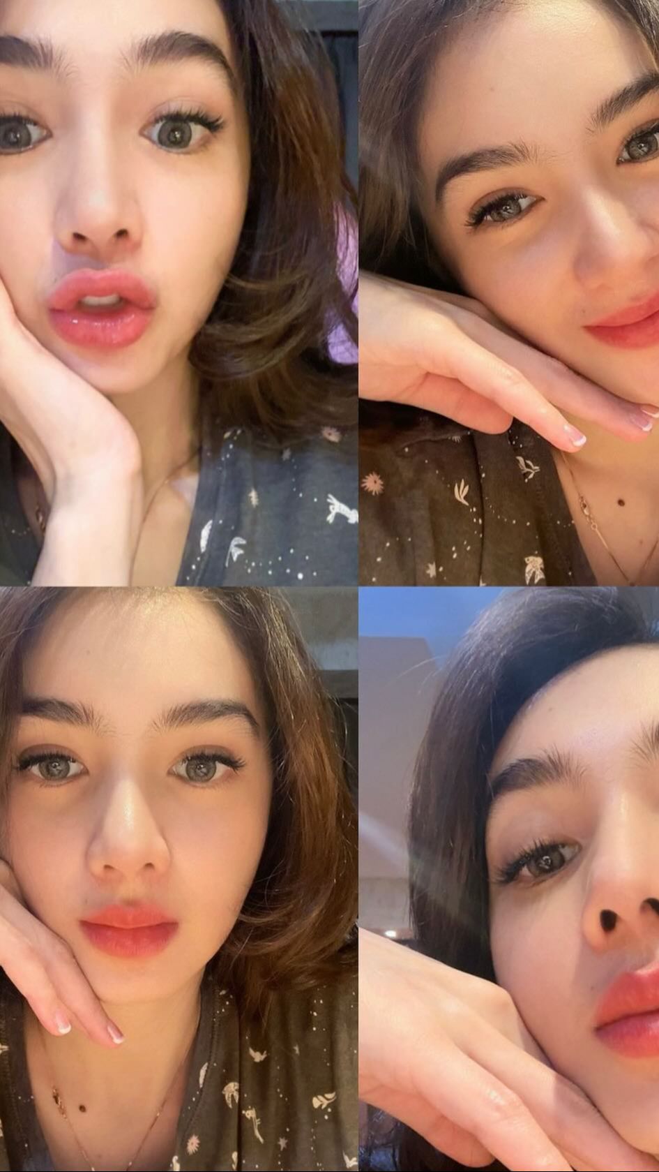 Rupanya Angel baru menjalani operasi plastik di bagian hidung. Namun penampilannya masih belum sempurna karena masih banyak bagian yang bengkak.