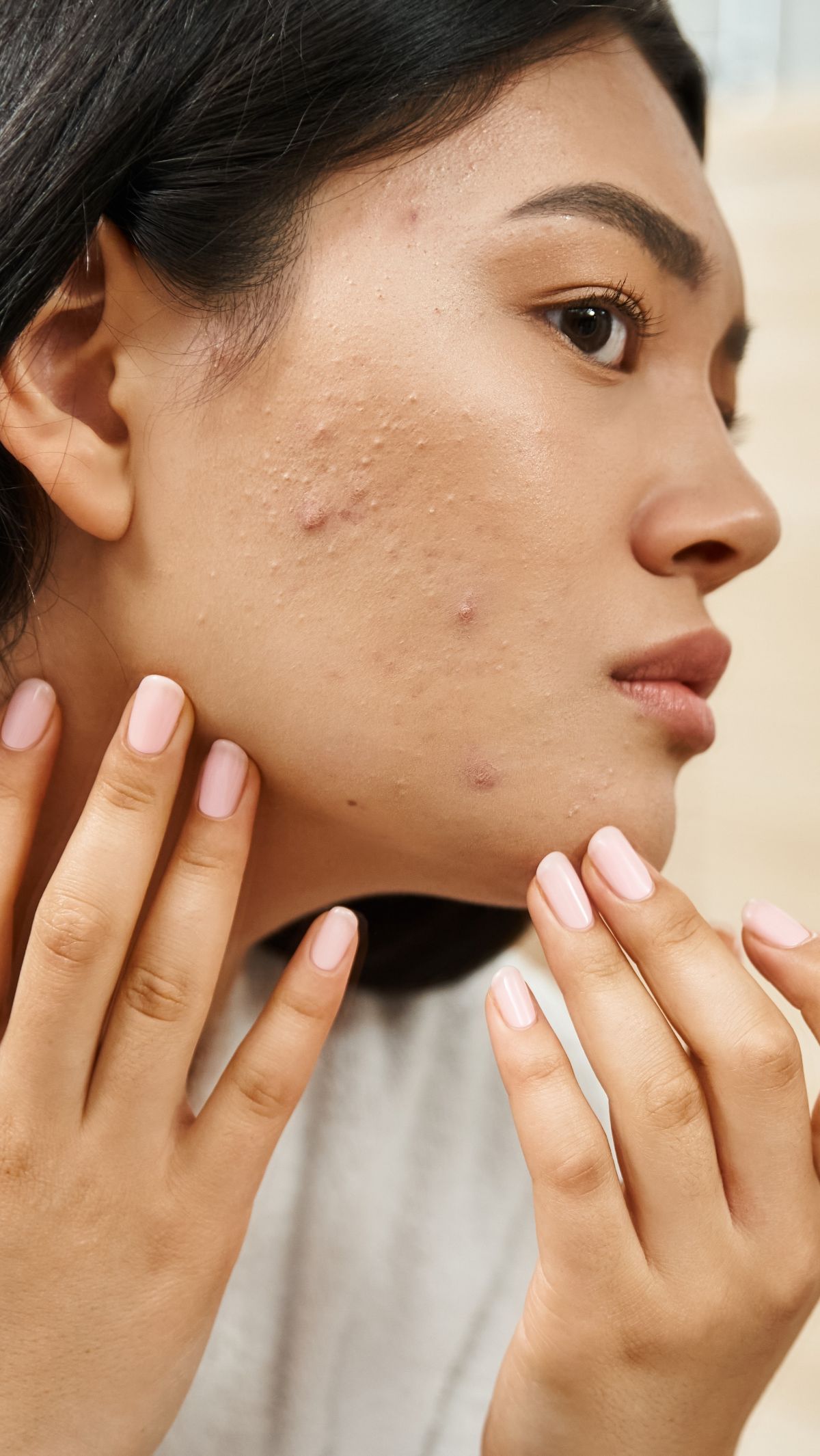 Tak Mempan Pakai Skincare, Coba 3 Prosedur  Atasi Bopeng  Rekomen Dokter Kulit