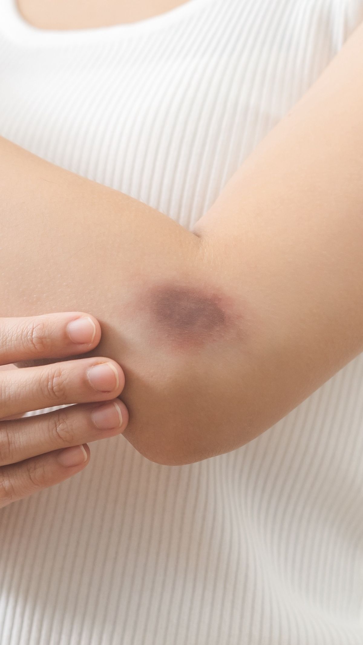 Tubuh Sering Tiba-tiba Memar? Bisa Jadi Karena Kurang Vitamin Ini