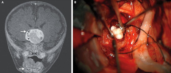 Aneh Tumor Dalam Otak Bayi Ini Bisa Tumbuh Gigi Merdeka Com