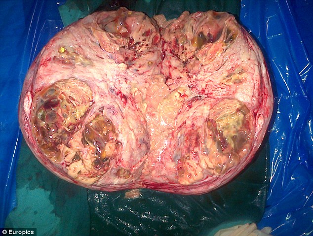 tumor Latha