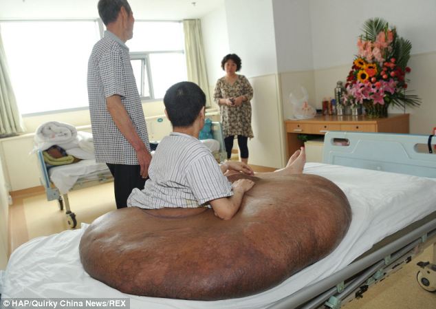 tumor 107 kg