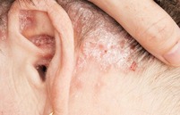 karena psoriasis