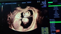 hamil anak kembar