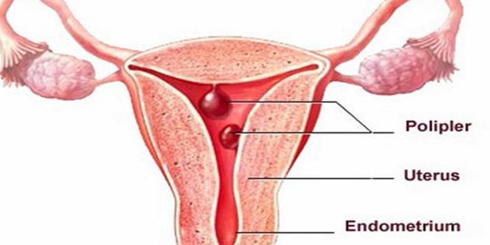 Hasil gambar untuk polip uterus