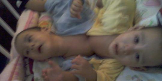 Bayi kembar siam dempet dada dioperasi di RS Sanglah
