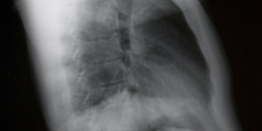 paru obstruktif kronis copd rev1