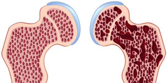 15 Makanan pelawan osteoporosis