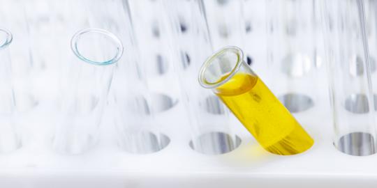 5 Hal yang bisa diungkap lewat urine