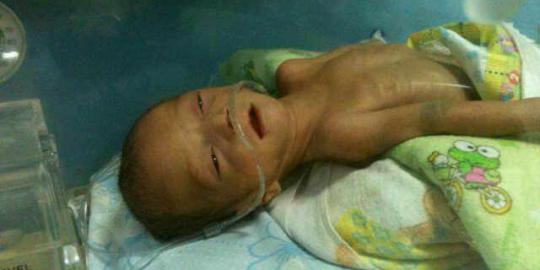 Berat hanya 1,4 kg, kembaran Dera masih dirawat di RS Tarakan