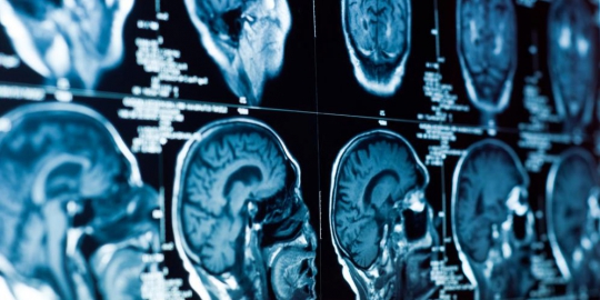 8 dampak mengerikan dari kurang tidur