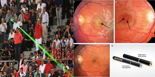 Laser pointer dapat membakar retina