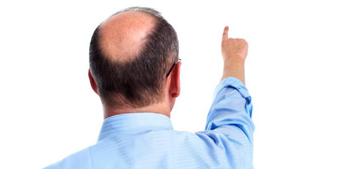 Pria botak lebih berisiko kena serangan jantung | merdeka.com