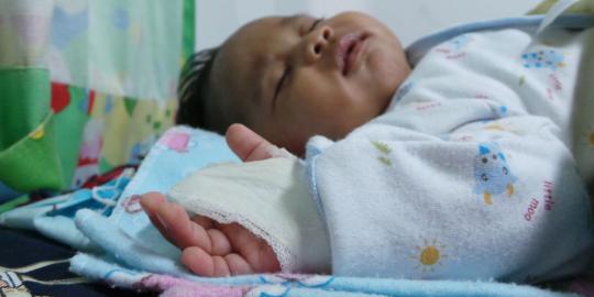 Bayi Edwien, jarinya diamputasi setelah membusuk