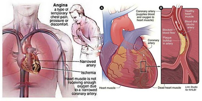 Apa Itu Angin Duduk Atau Angina Merdeka Com