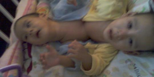 Bayi kembar tiga, dua dempet dada lahir di Banyuwangi
