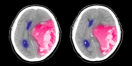 8 masalah kesehatan yang muncul akibat apnea tidur