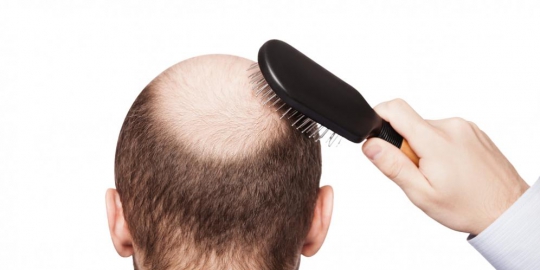 4 masalah rambut yang mengindikasikan kesehatan