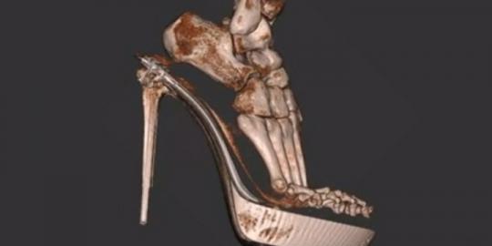 3D scan tunjukkan bagaimana high heels merusak kaki