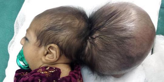 Bayi Afghanistan lahir dengan kepala tambahan