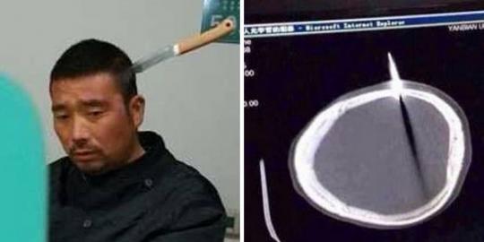 Lelaki China datangi rumah sakit dengan pisau menancap di kepala