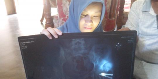 Ditabrak polisi hingga kaki patah, Putri justru jadi tersangka