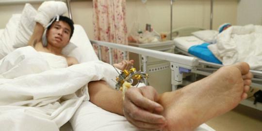 Dokter di China cangkok tangan seorang pria ke pergelangan kaki