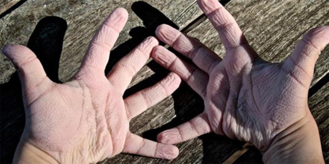 Image result for kulit jari berkerut saat kena air