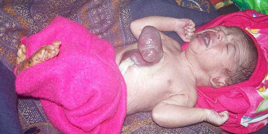 Lahir dengan jantung di luar tubuh, bayi ini bertahan hidup