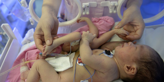 Bayi di China lahir dengan empat kaki dan empat tangan