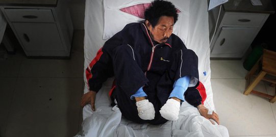 Terlalu miskin, petani China amputasi sendiri kakinya