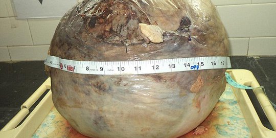 Ngeri, tumor seberat 15 kilogram ada dalam rahim wanita India