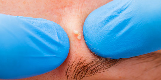 5 Penyebab acne rosacea yang wajib diketahui